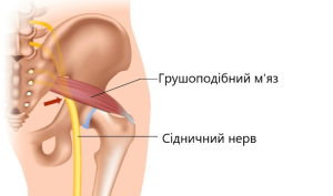 Синдром грушоподібного м’яза: як він пов’язаний із хребтом