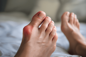 Кістка на нозі (hallux valgus): чому вона росте