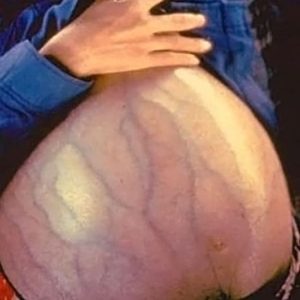 Асцит при захворюваннях печінки