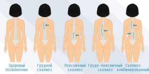 Чому при сколіозі у дітей з’являється різна висота лопаток.